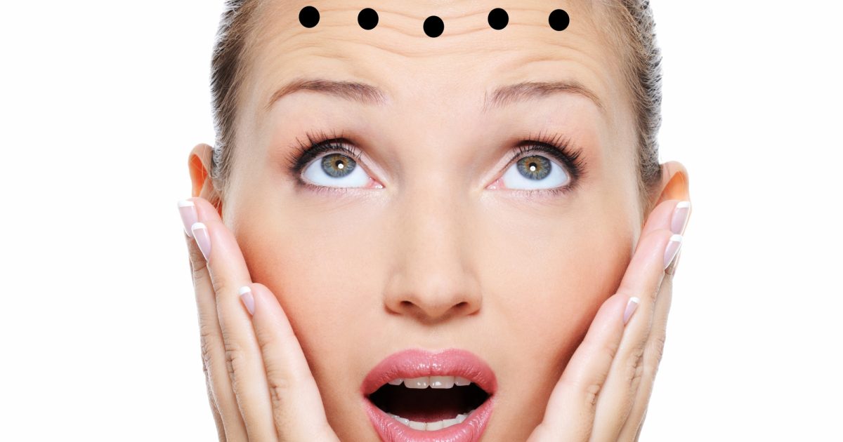 Botox-injection-sites-Forehe