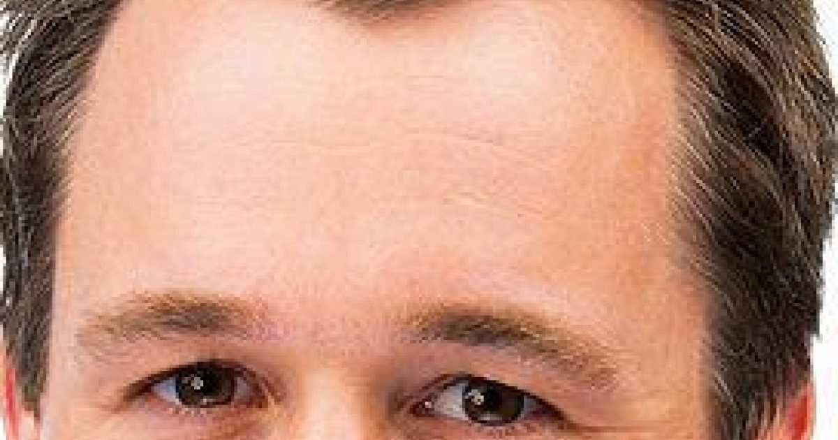 brow-lift-patient