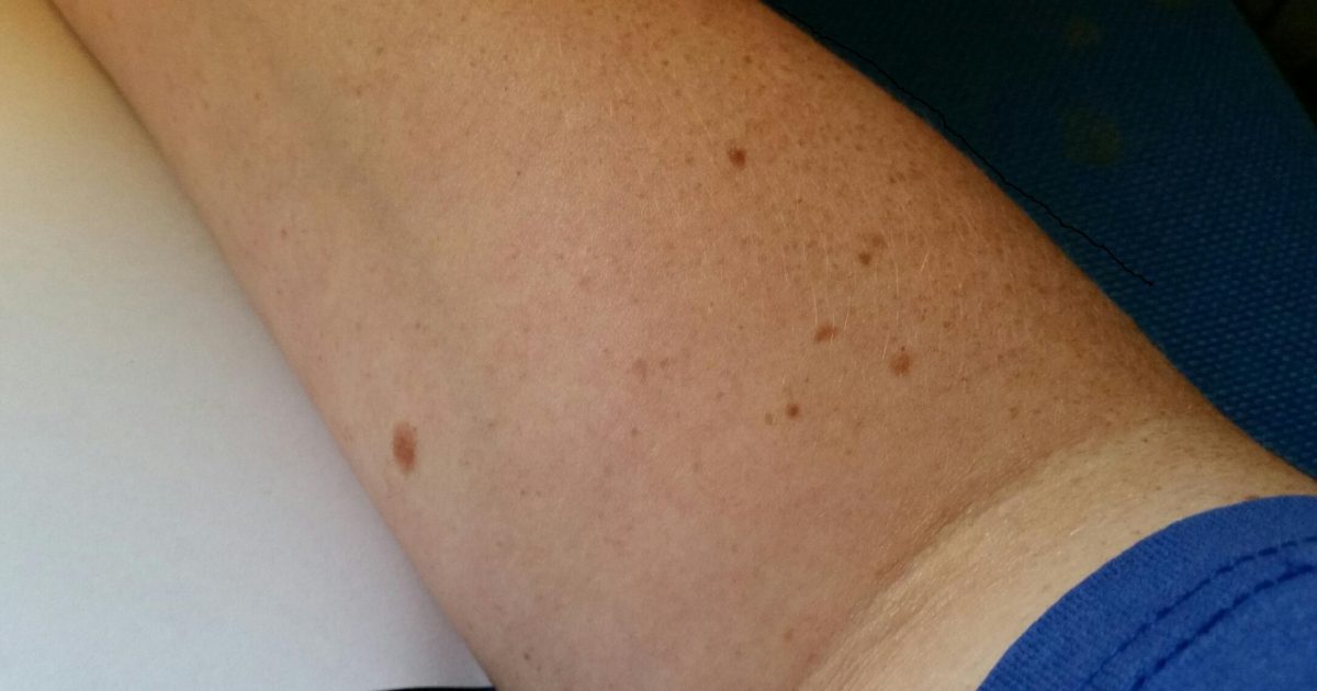 moles