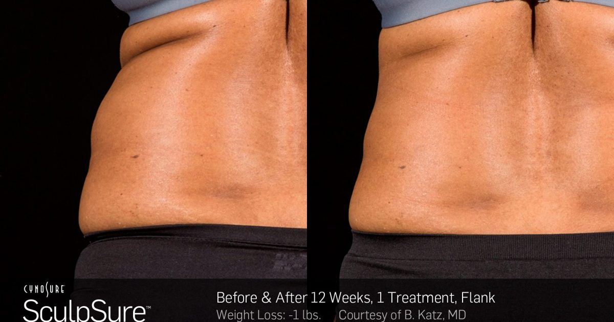 sculpsure-bxa-12b